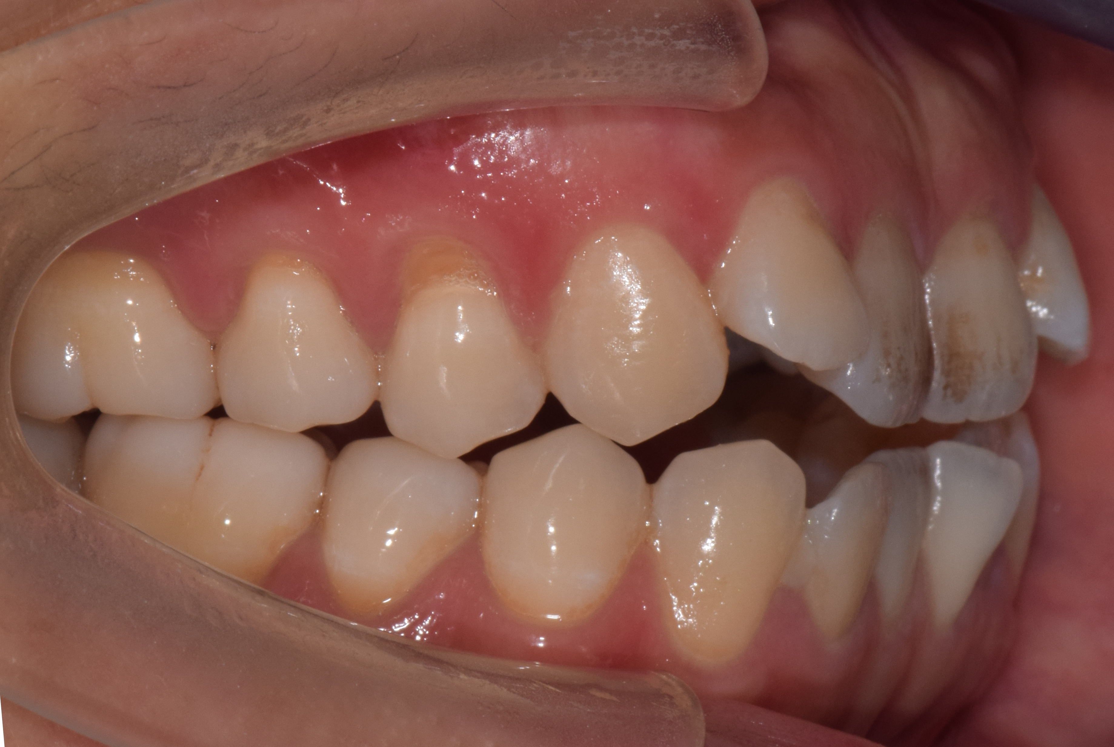 开颌矫正第一招压低后牙前旋下颌