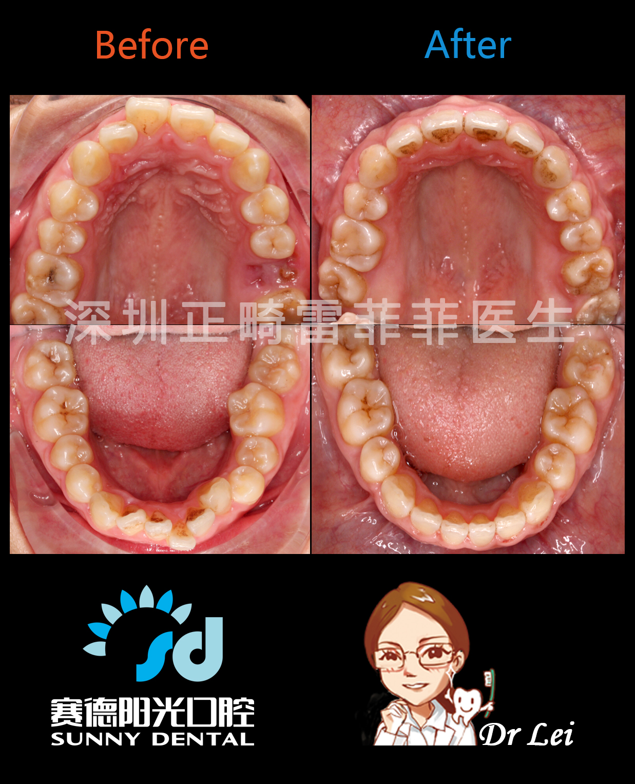 骨性上頜前突下頜後縮的單純正畸治療