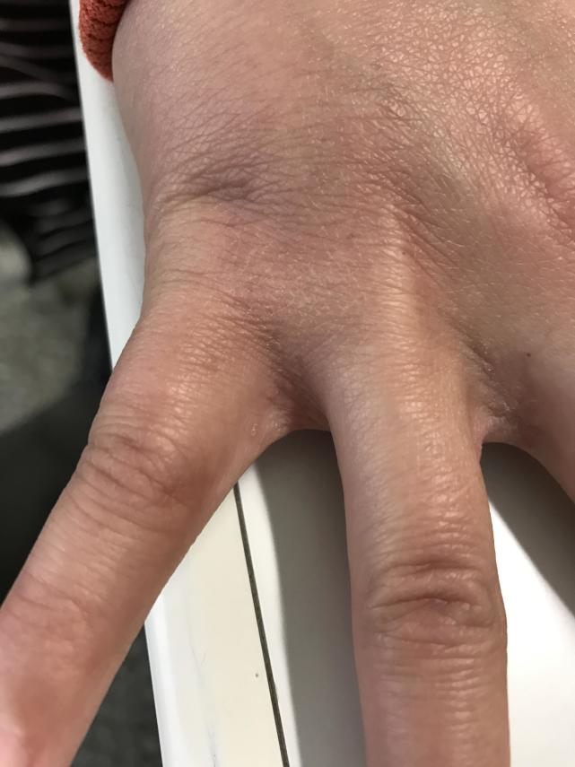 宝宝被传染了疥疮,大都是父母的疏忽大意导致的!