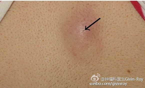 粉瘤真的可以不用管吗