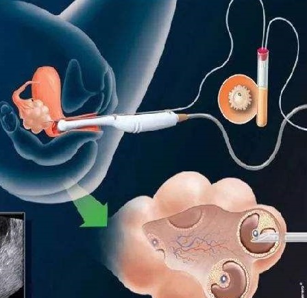 做试管婴儿取多少枚卵子是最好的?