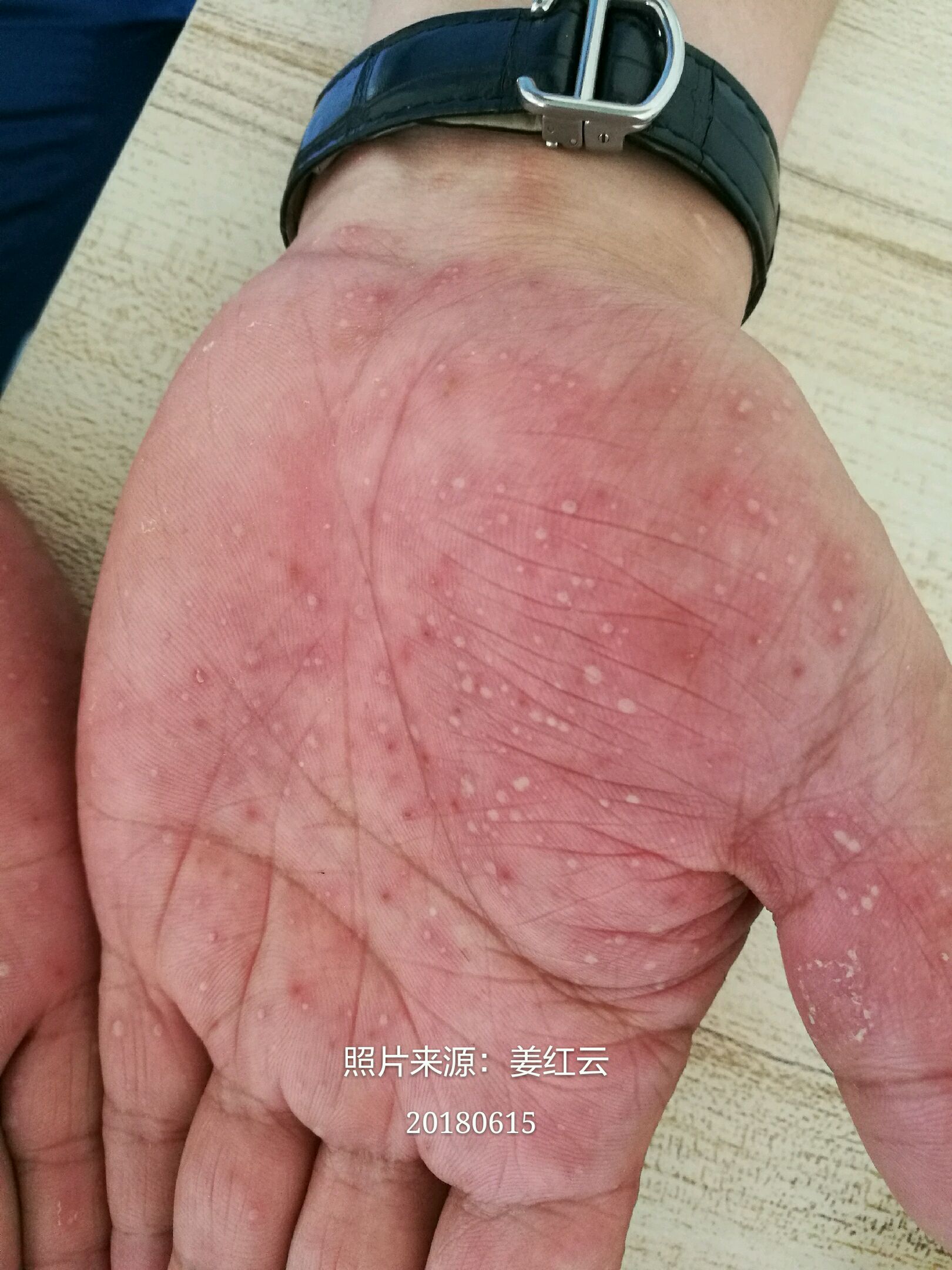 手脚反复起脓疱是什么病