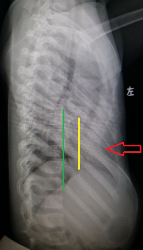 入院查体发现,患儿胸前重度凹陷,以剑突附近明显.