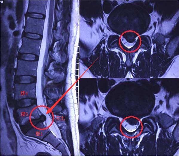 腰5骶1椎间盘突图片