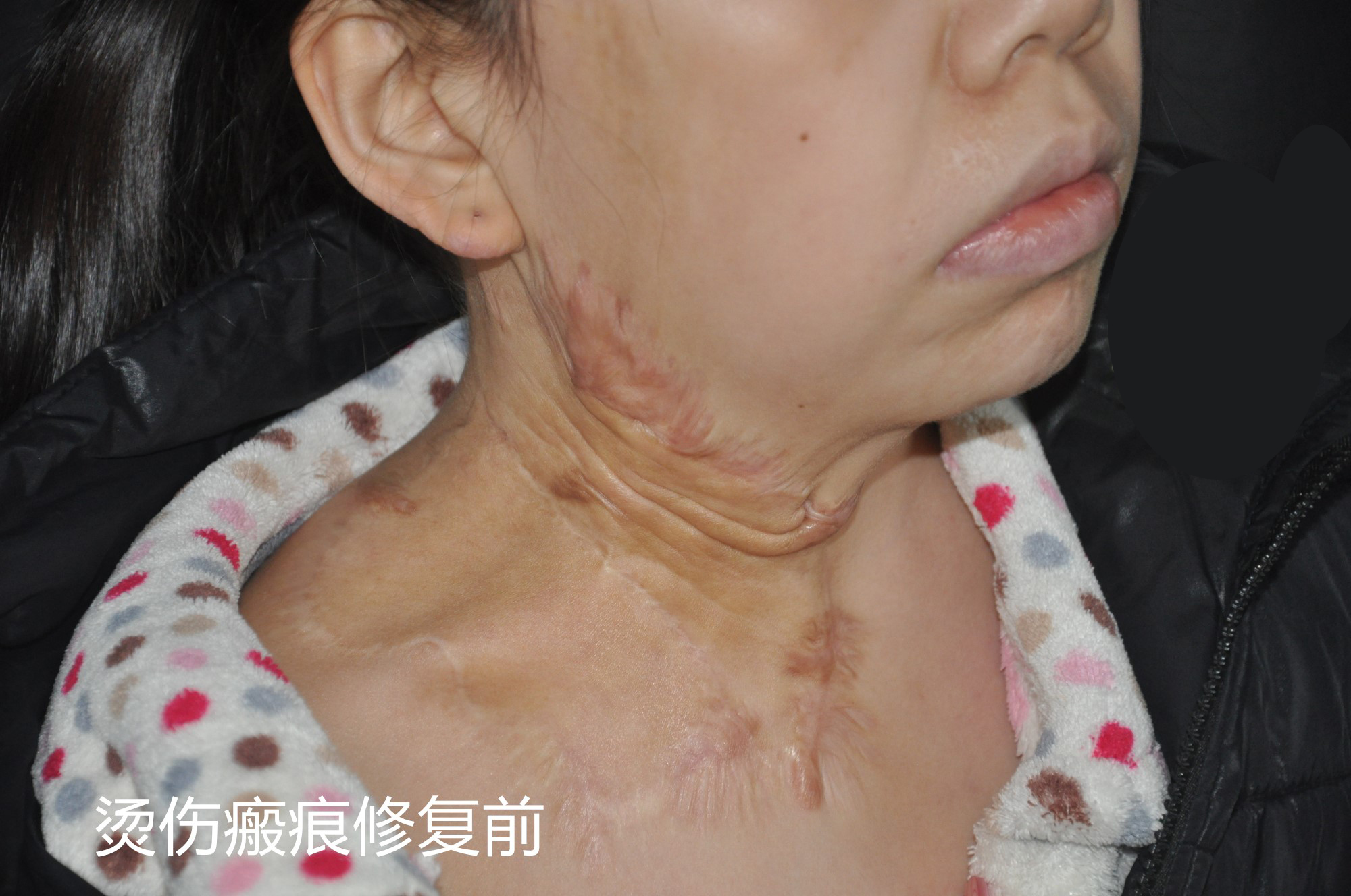 瘢痕修复案例带你了解神奇的扩张器