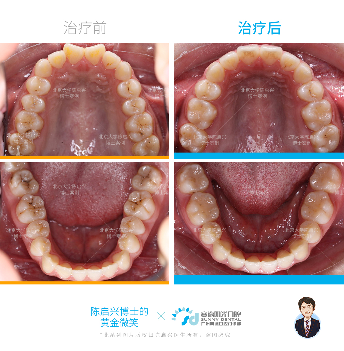 真人案例:單純正畸解決嘴突 牙齒不齊