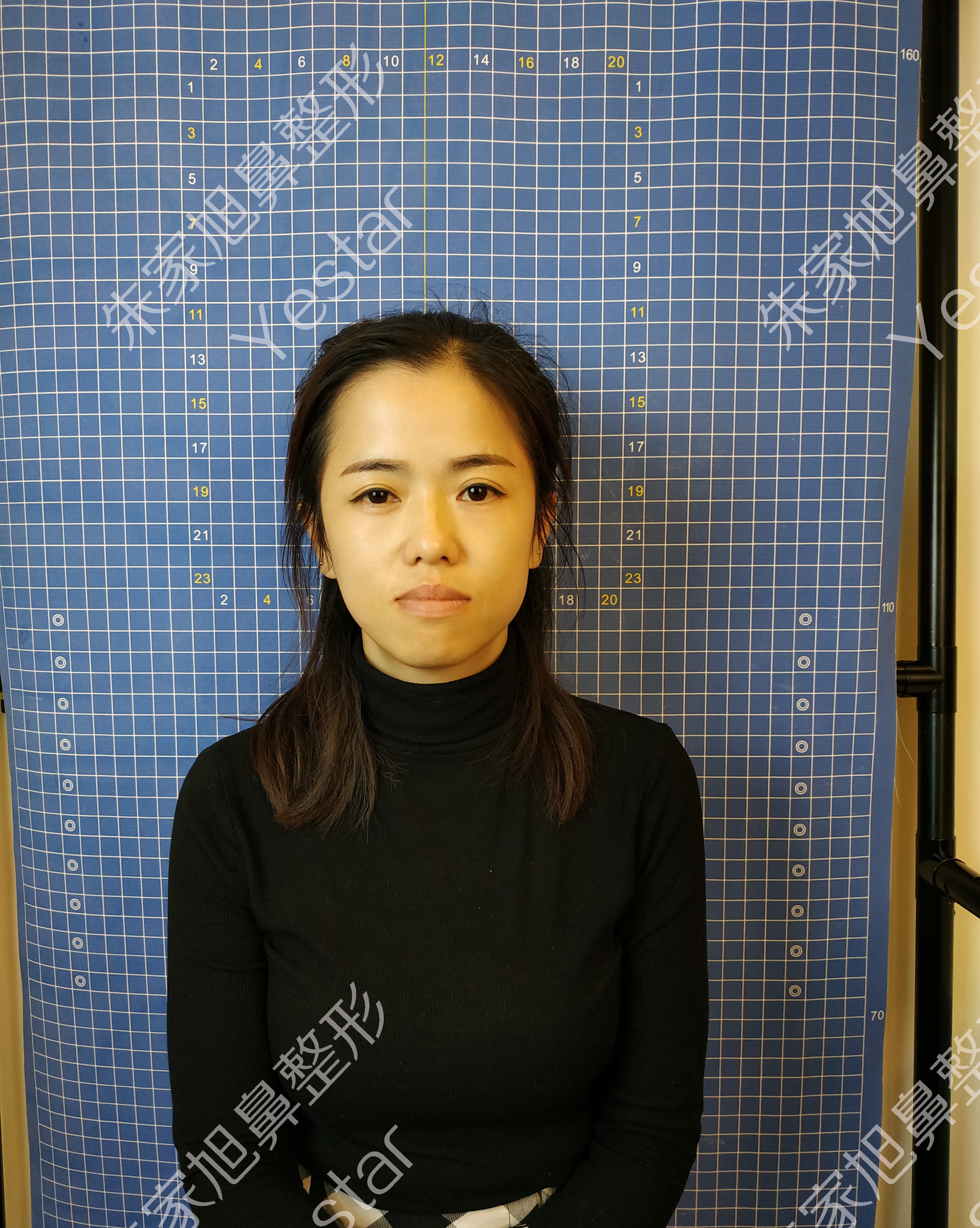 低鼻短鼻案例分享和术后恢复情况