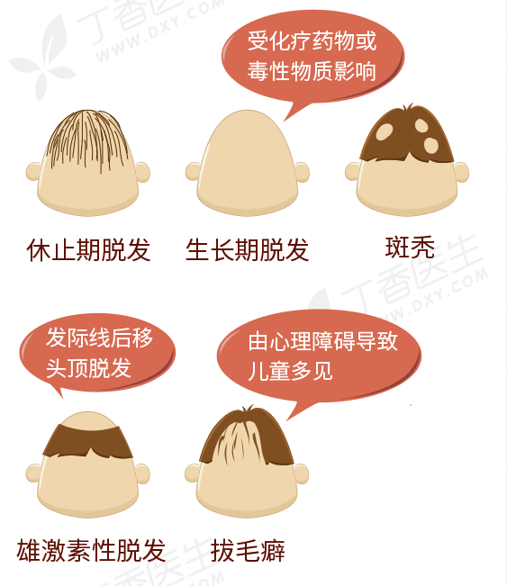脱发类型.gif
