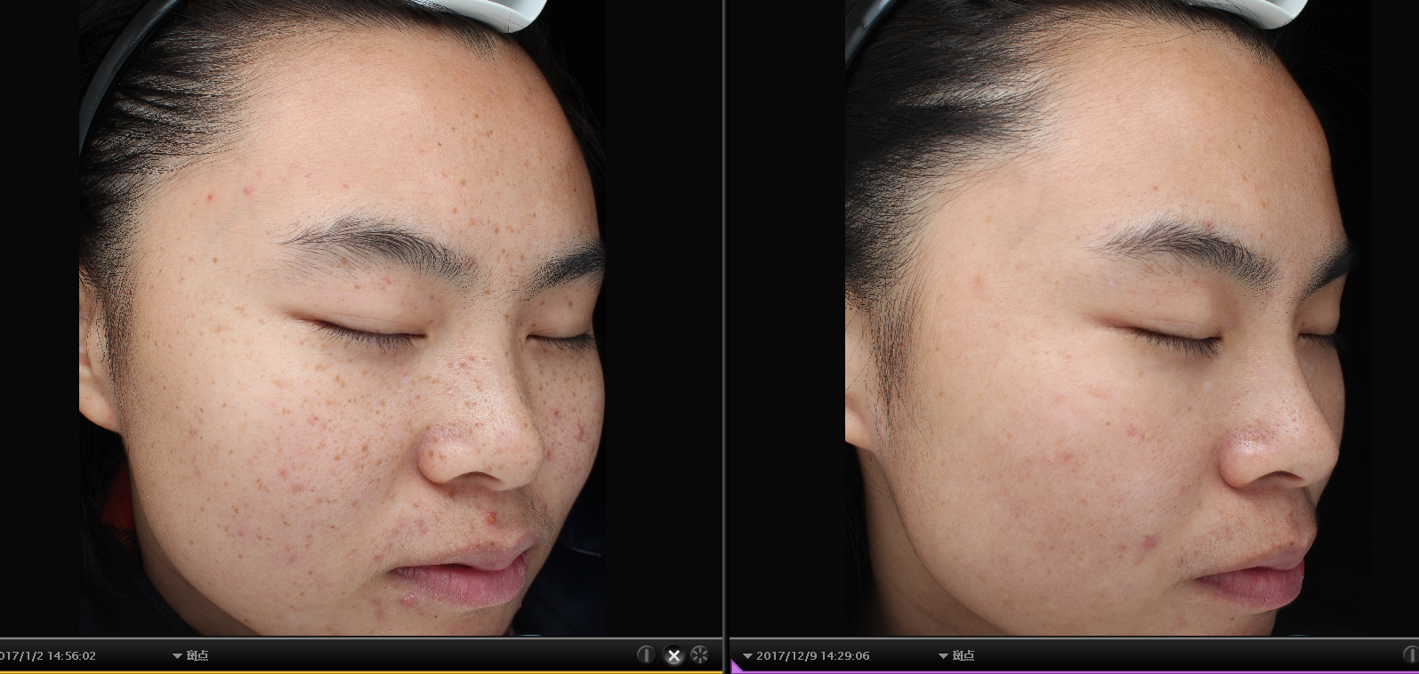 春天里雀斑冒要激光