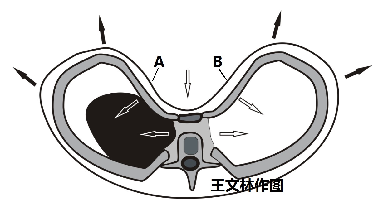 矛盾運動:胸廓畸形前胸壁運動方向的異常
