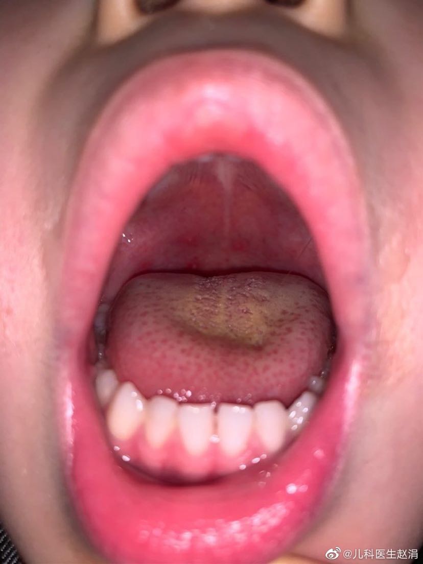 咽峡炎疱疹 初期图片