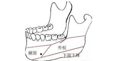 做完下颌角脸比以前还宽,难道是做了一个假手术吗?