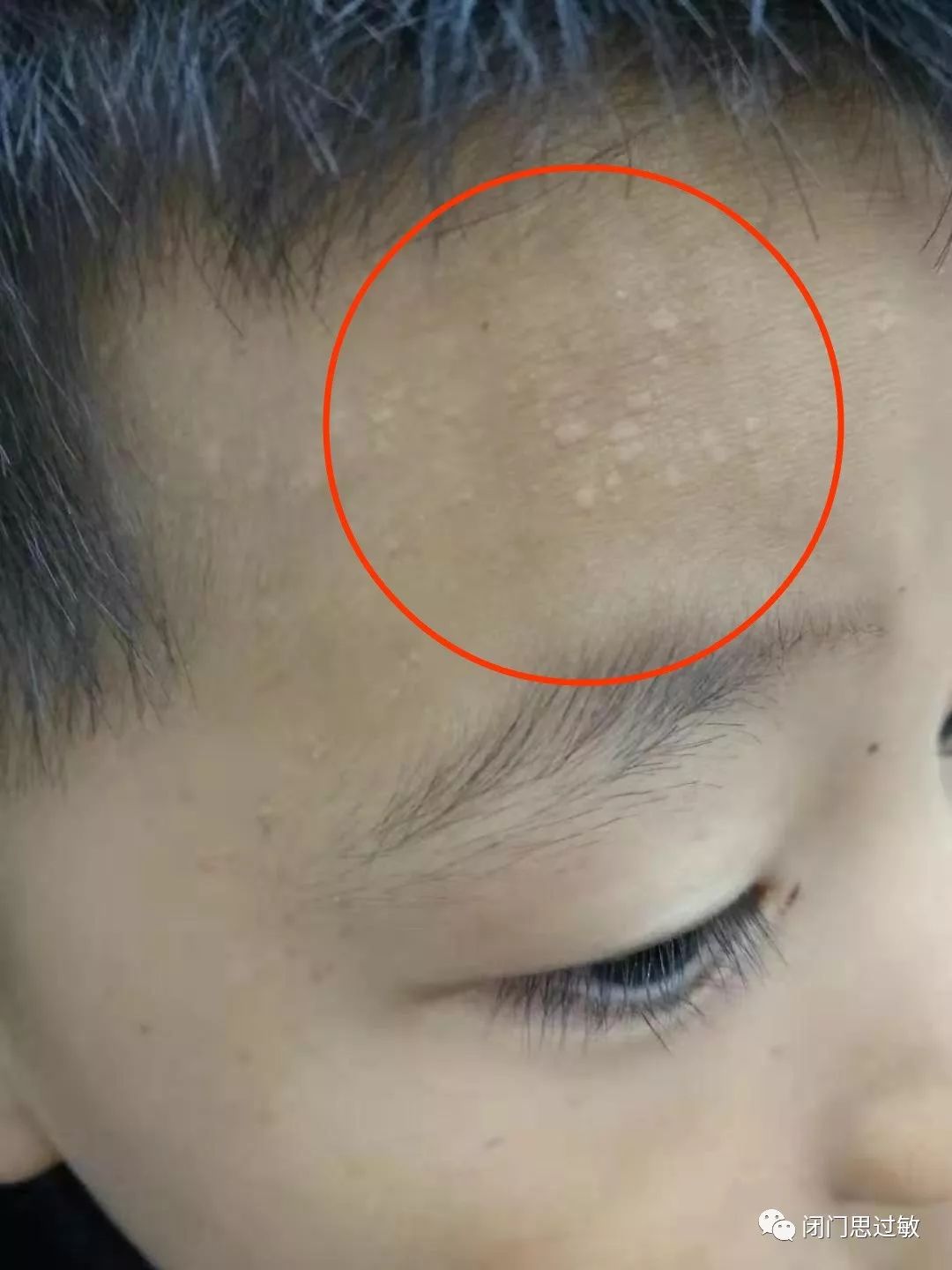 那个叫"西瓜"的皮肤病是啥?
