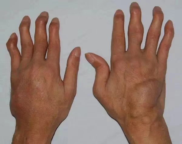 手指关节错位的表现图片