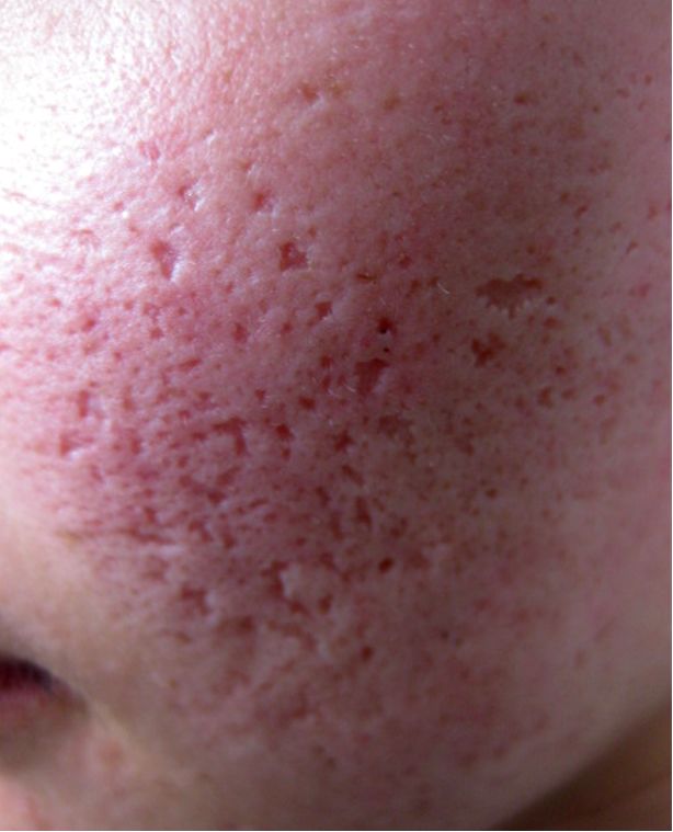 光电技术在痤疮后遗皮损治疗的应用