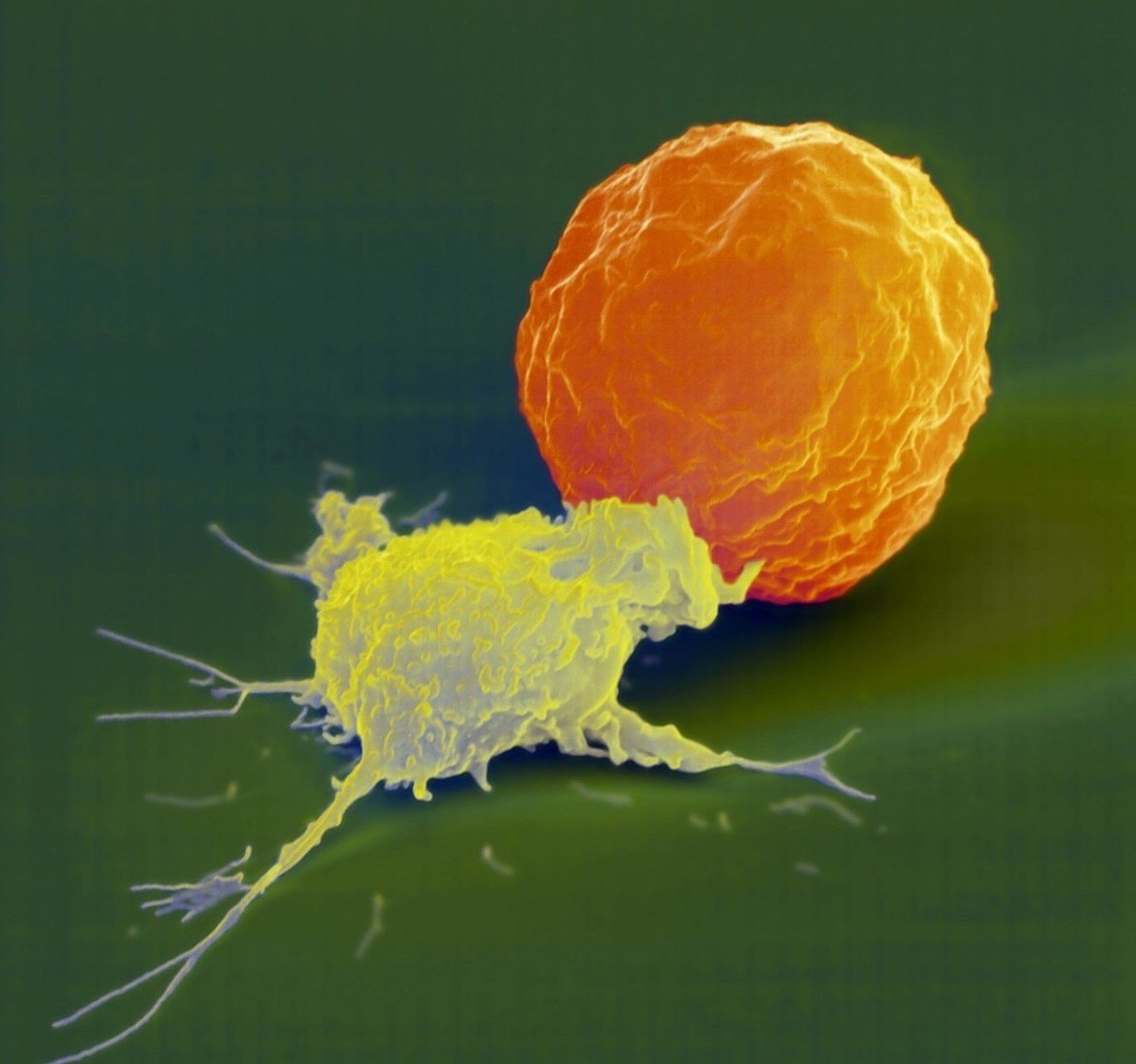 癌细胞突变的诱因终于水落石出这类细胞会酿造成癌