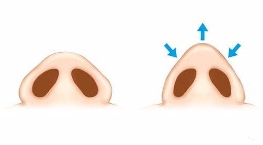 做鼻整形你最担心的是什么科普问答