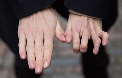 掰手指,会不会得关节炎?