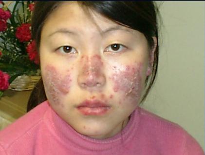 系统性红斑狼疮诊疗的常见误区