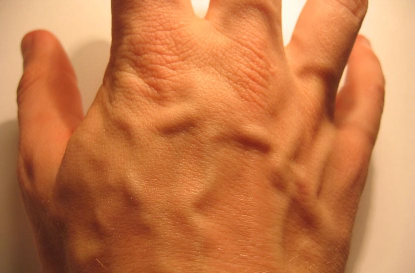 手背血管可反应身体内在病变