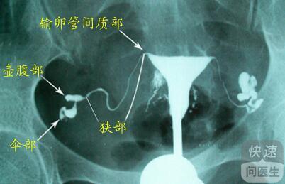 做輸卵管造影前要做什麼檢查