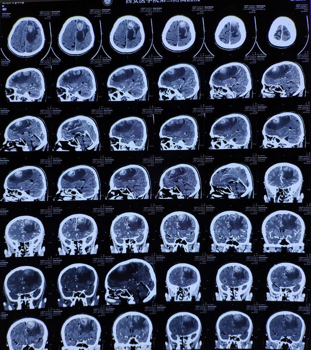 右侧肢体无力检查后竟是恶性脑肿瘤