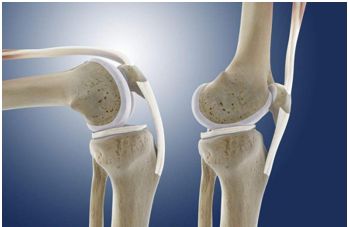 膝关节是一个滑车关节,髌骨会在滑车里来回滑动,当膝内扣的时候,股四