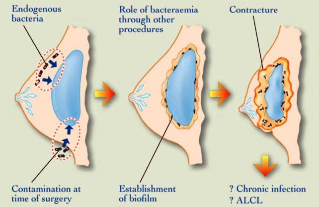 假体隆胸后的不良反应—包膜挛缩