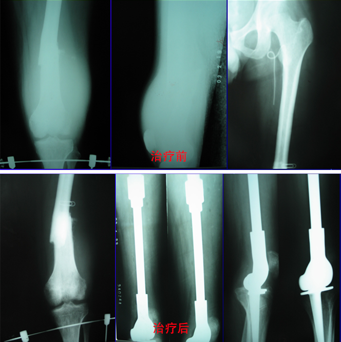 骨肉瘤明顯病理骨折的保肢治療 29歲 股骨下段骨肉瘤伴有明顯病理骨折