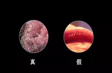 尖锐湿疣可以彻底治愈吗?需要多久?