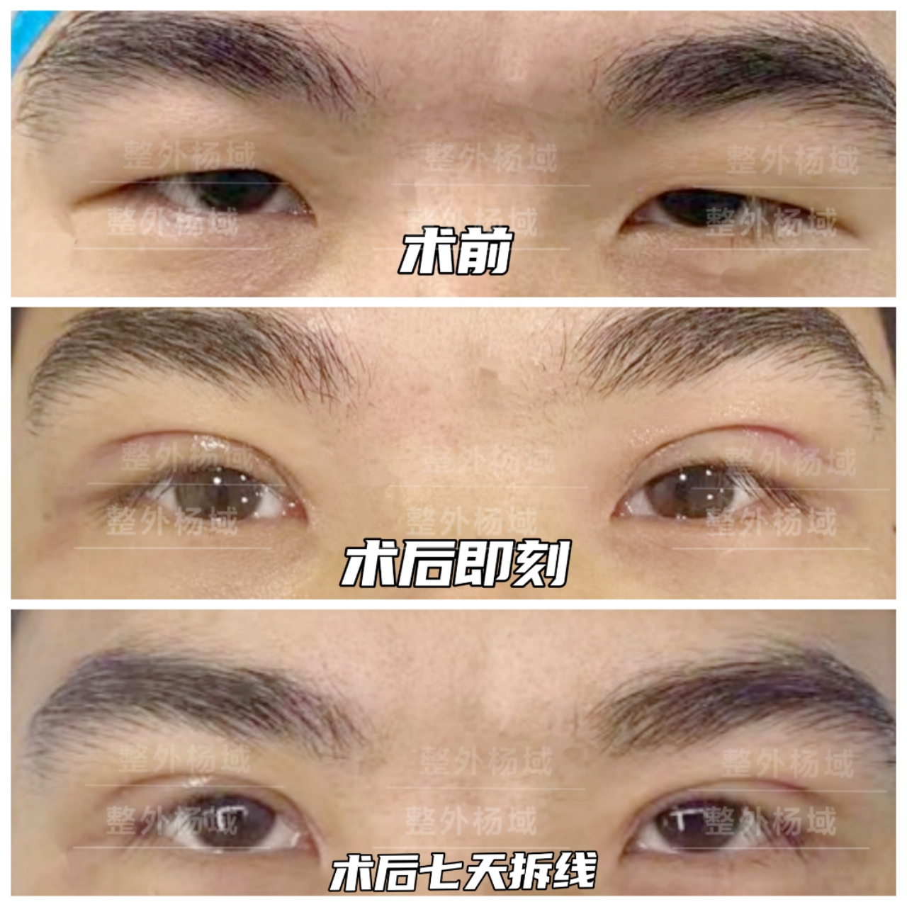 【整形科普】男生双眼皮应该如何选择?