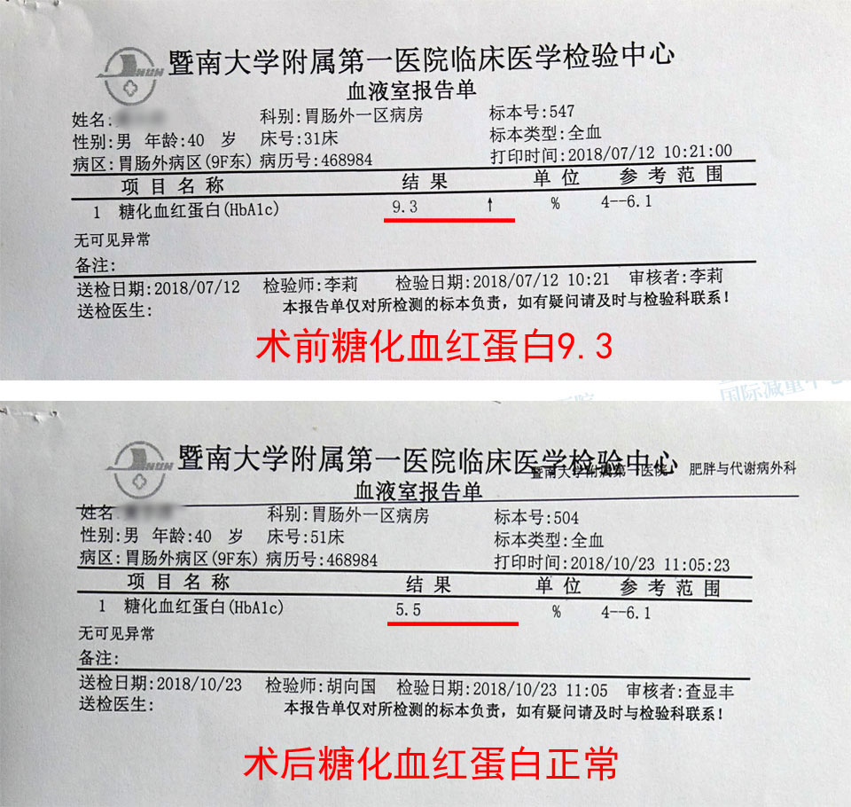 511中国肥胖日2019主题:肥胖与糖尿病 糖尿病手术案例三