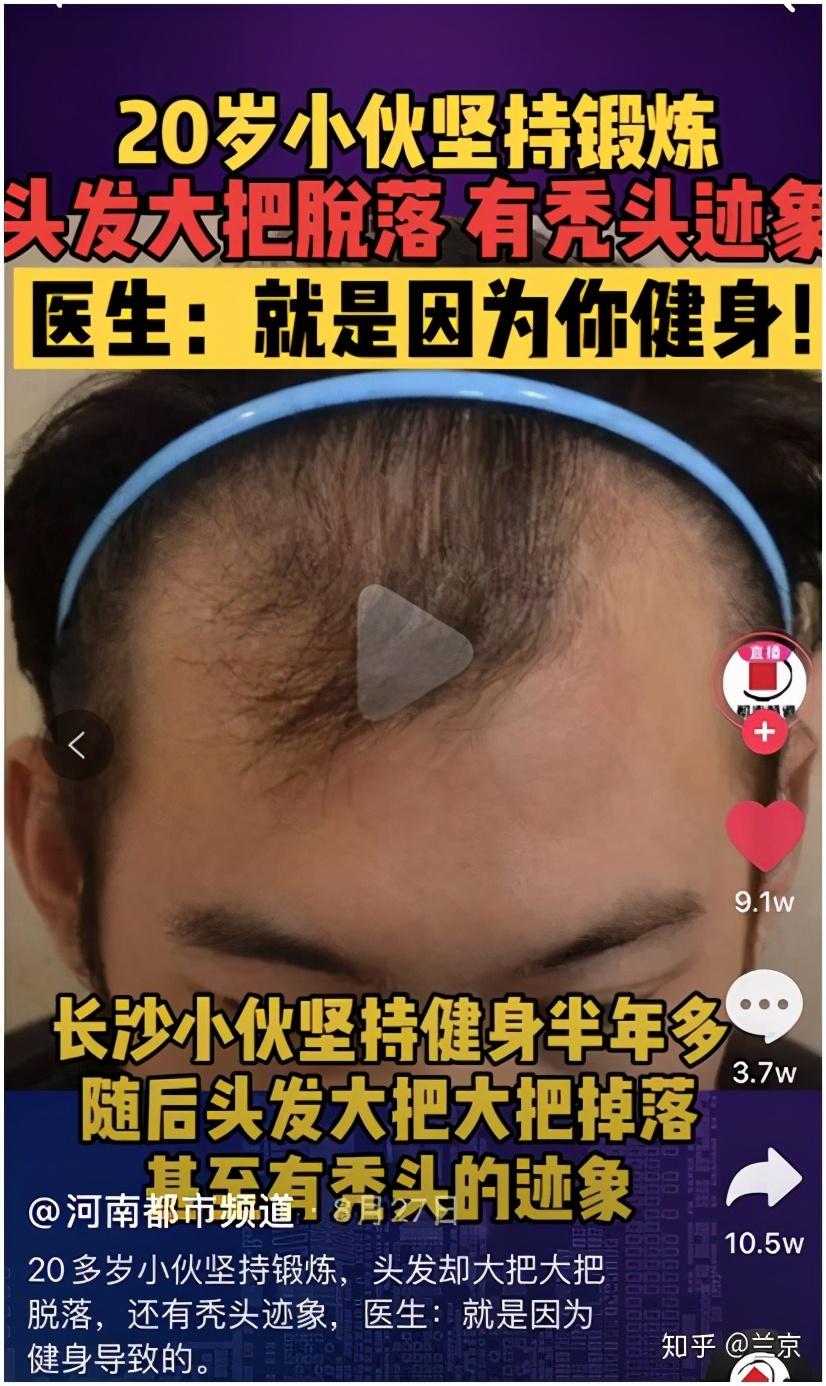 雄性脱发的最后归宿是什么 秃顶如何改善 刘长春主治医师 爱问医生 雄性脱发的最后归宿是什么 秃顶如何改善 刘长春主治医师 爱问医生