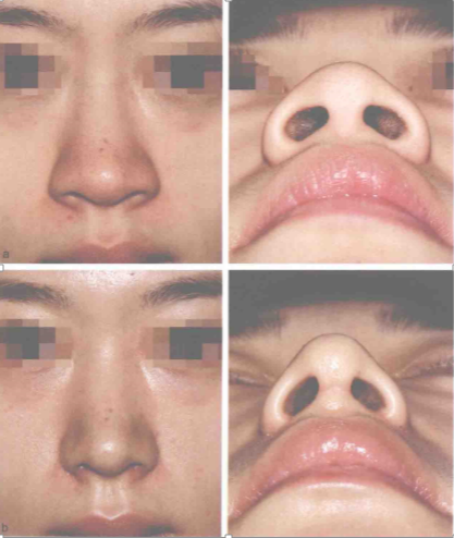【手术方法】鼻翼鼻孔缩小术,术前术后对比,术中过程演示