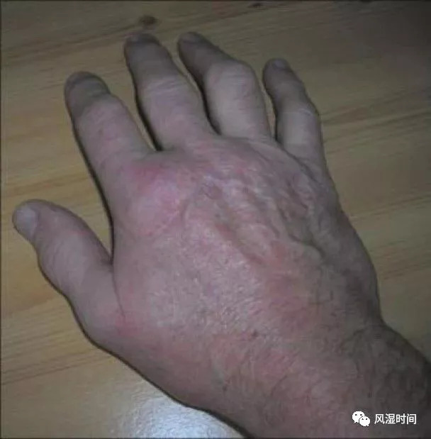 样改变:肿胀,皮肤发红等5治疗hh 治疗的核心是去除铁,常规用放血疗法