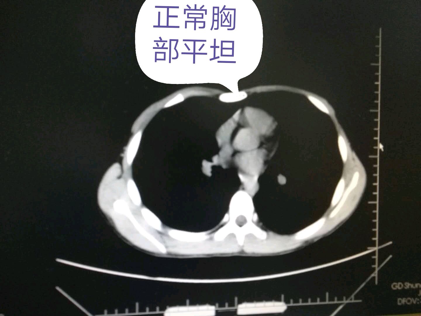 鸽子胸（Wenlin胸）手术之革命:从改良Wang手术到Wenlin手术_胸骨