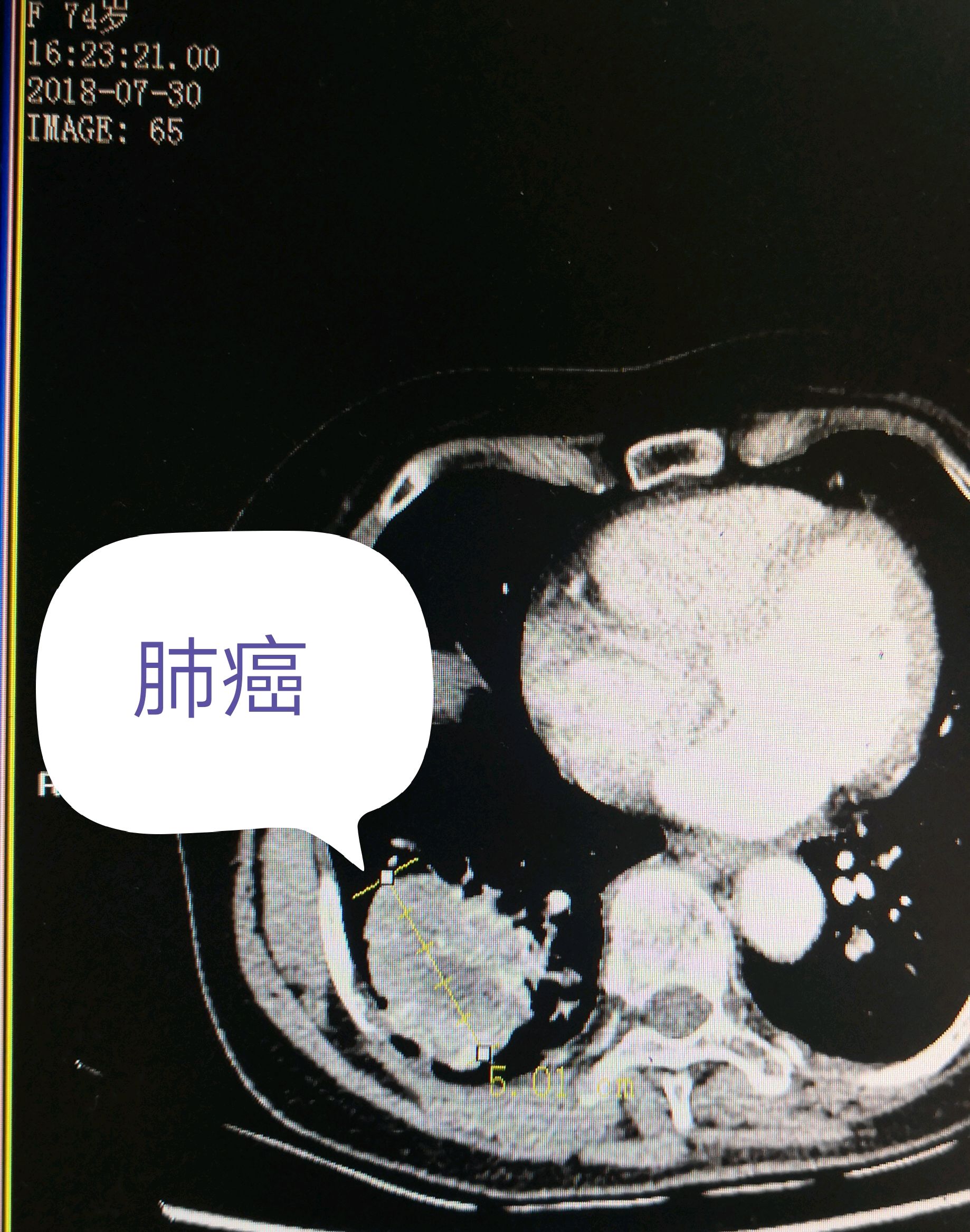 74岁农村阿婆也会得肺癌住在青山绿水吃的绿色食品为什么