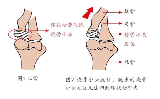 head subluxation, rhs)也称为"保姆肘","牵拉肘"和"环状韧带移位"