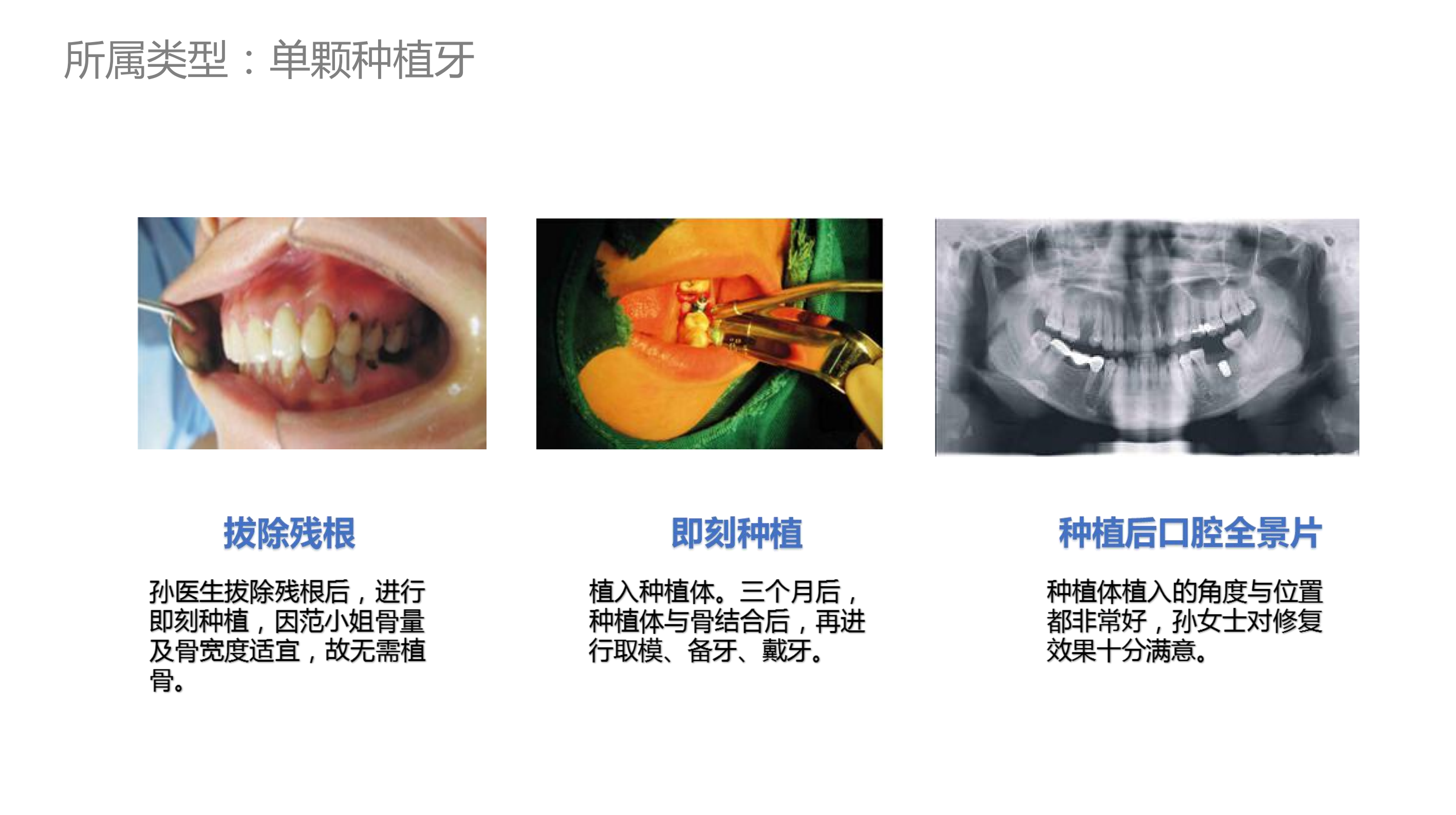 傅氏口腔种植真实案例