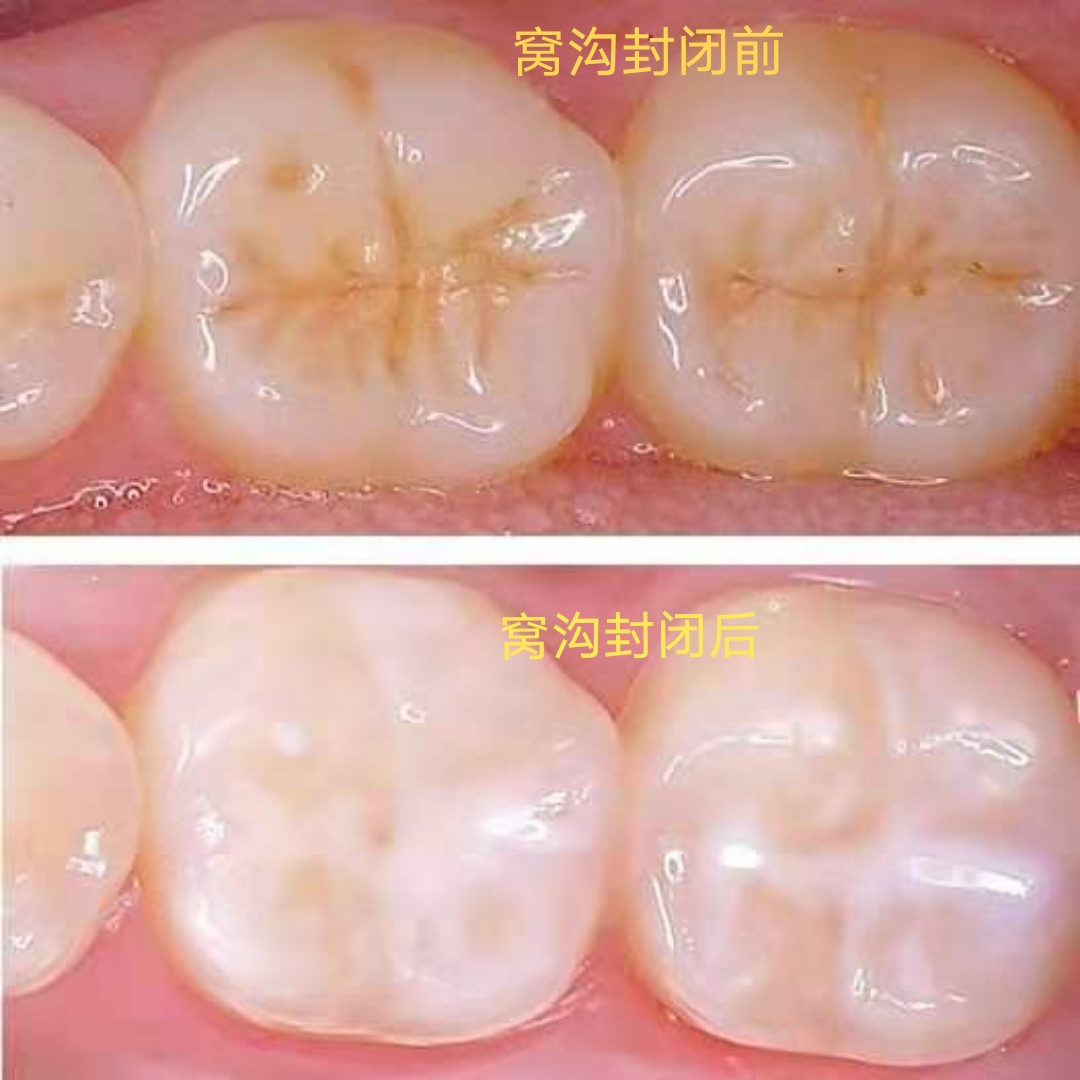 怎樣才能讓孩子遠離蛀牙——窩溝封閉