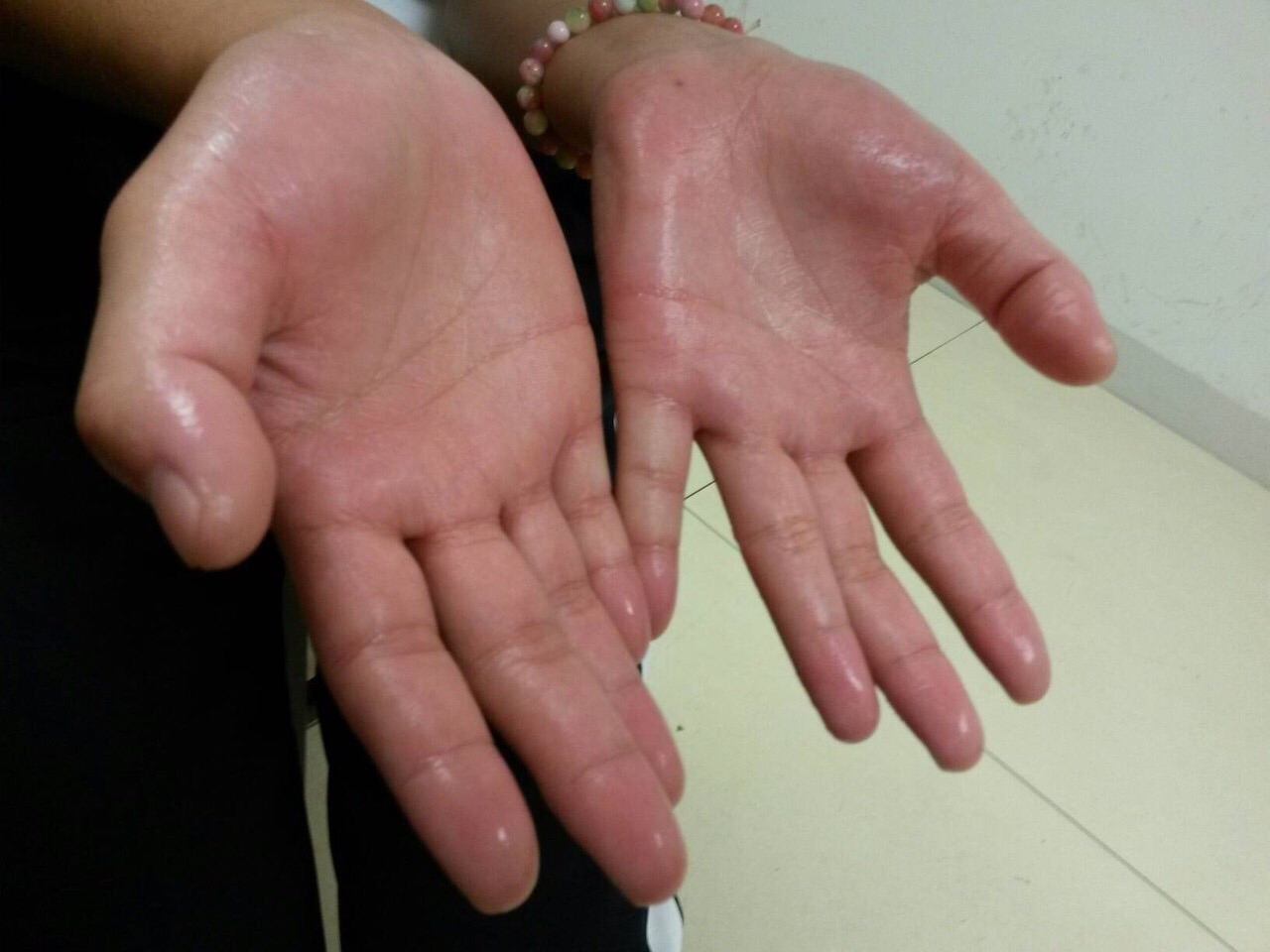 微创手术治疗手汗症简单安全有效