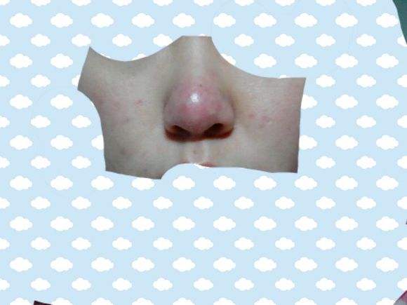 酒糟鼻能治好吗?