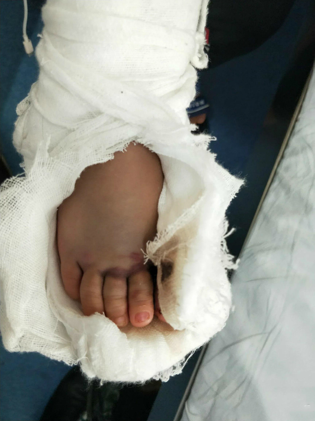 女孩惊险上学记上学途中脚被车碾医生说送晚一点脚就没了