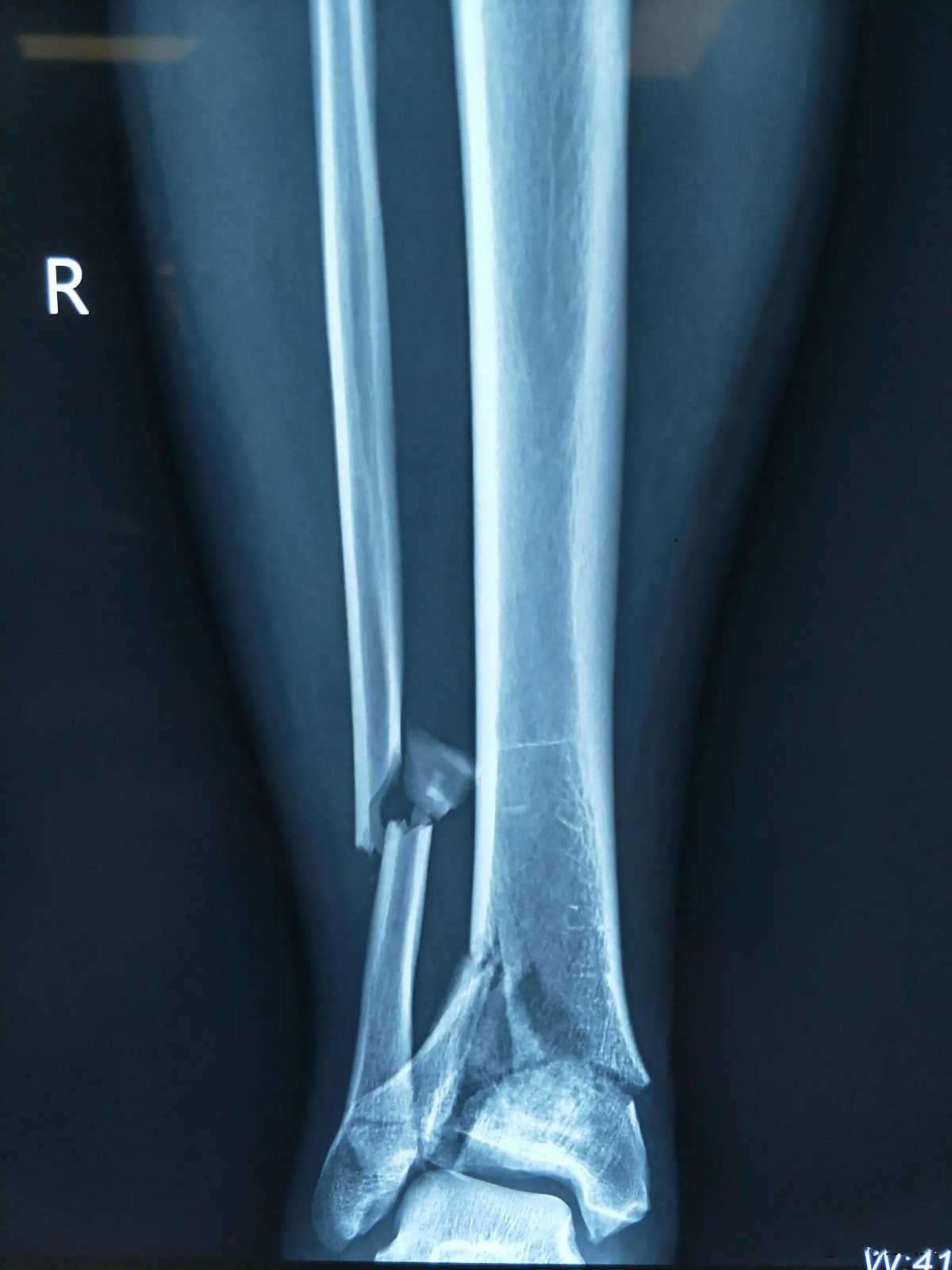 胫骨粉碎性骨折有可能完全恢复正常吗?-姚京辉副主任医师-爱问医生