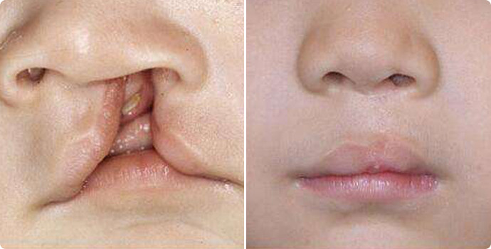 先天性口腔内腭裂图片图片