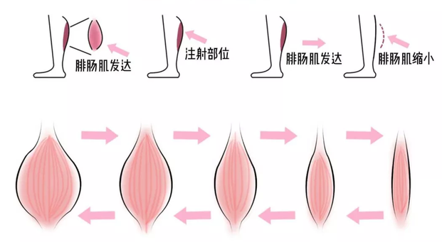 肉毒素瘦小腿