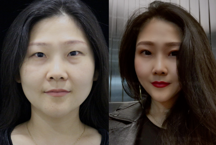 学会审美丨眼修复中的大部分改形态手术都是因为当初选错形状