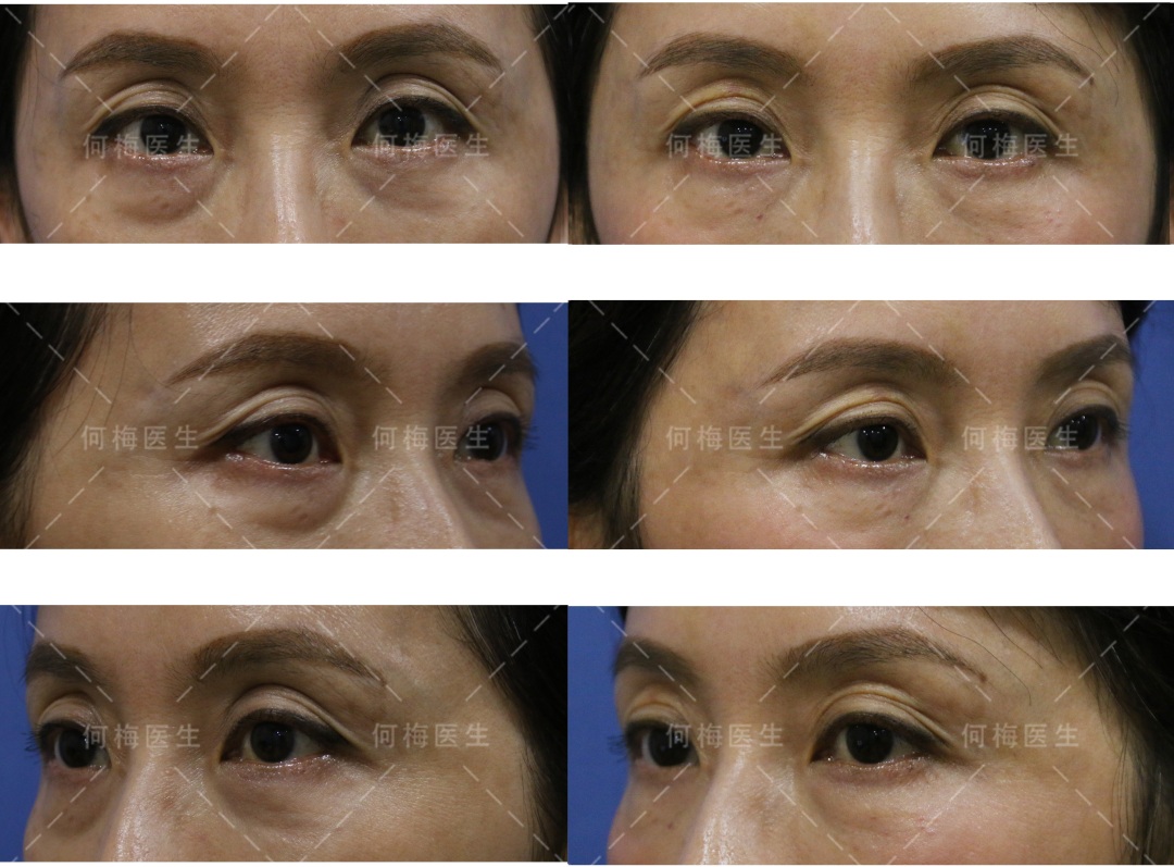 史上最全黑眼圈攻略