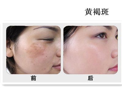 黄褐斑,中医如何治疗本病?
