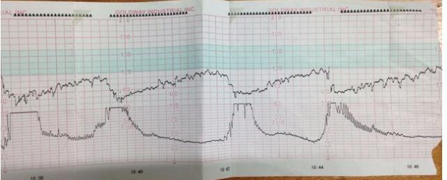 孕晚期发现胎心监护不好怎么应对？